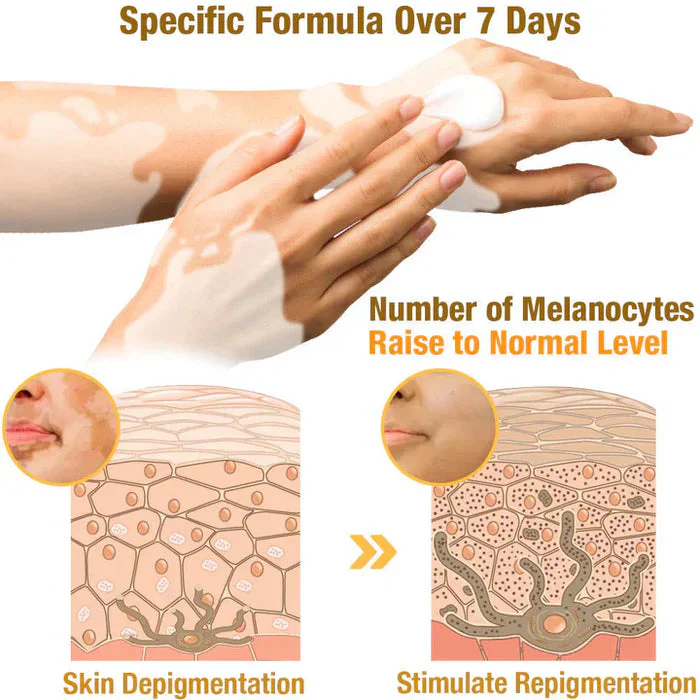VitiGO™ Vitiligo Corrector Cream - BUY 1 GET 1 FREE 🔥