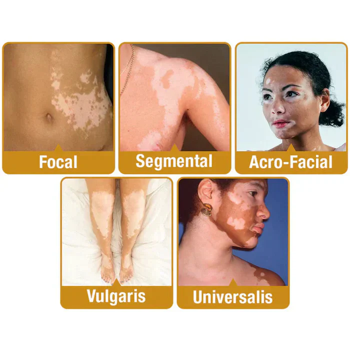 VitiGO™ Vitiligo Corrector Cream - BUY 1 GET 1 FREE 🔥